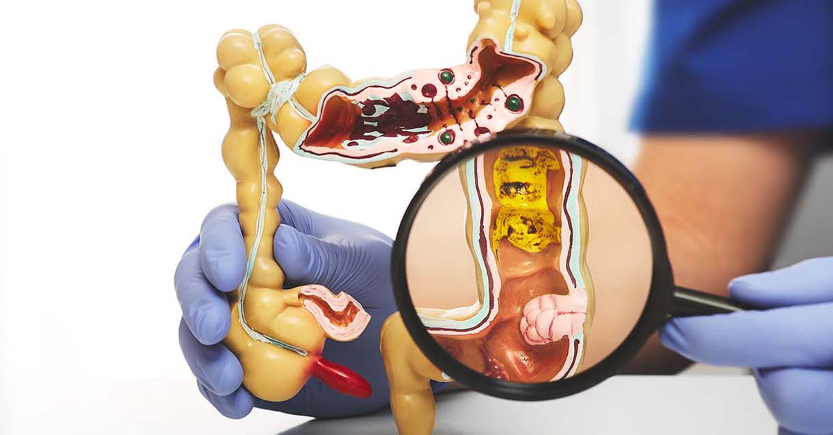 How Melbourne Clinics Personalize Rectal Cancer Treatment Plans How Melbourne Clinics Personalize Rectal Cancer Treatment Plans